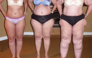 Ouranios in Amsterdam heeft meer kennis over lipo-oedeem als aanvulling op manuele lymfedrainage